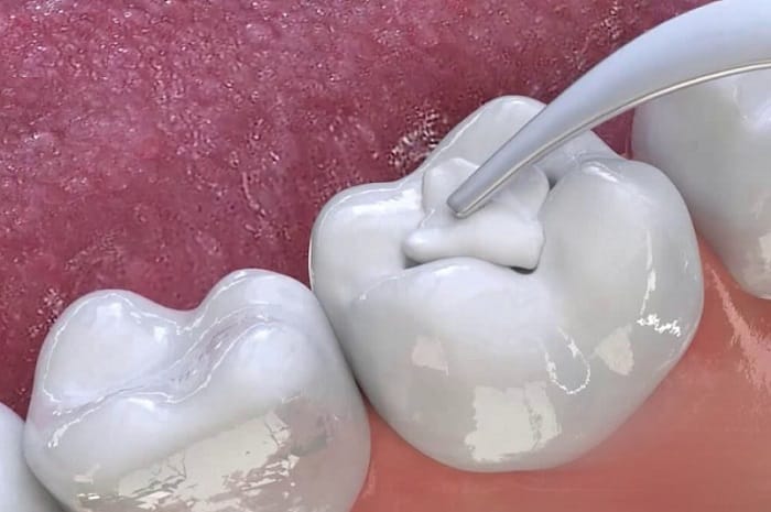 Xi măng nha khoa được dùng trong các ca phục hình đòi hỏi độ chính xác cao
