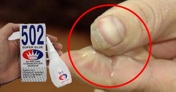 Keo dán sắt dính tay không chỉ gây nóng rát, khó chịu, có thể ảnh hưởng đến biểu bì da bị keo tiếp xúc